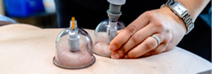 Gerando resposta  Copilot said: Close-up of suction cups applied to a person’s back while a hand adjusts one of the transparent cups.